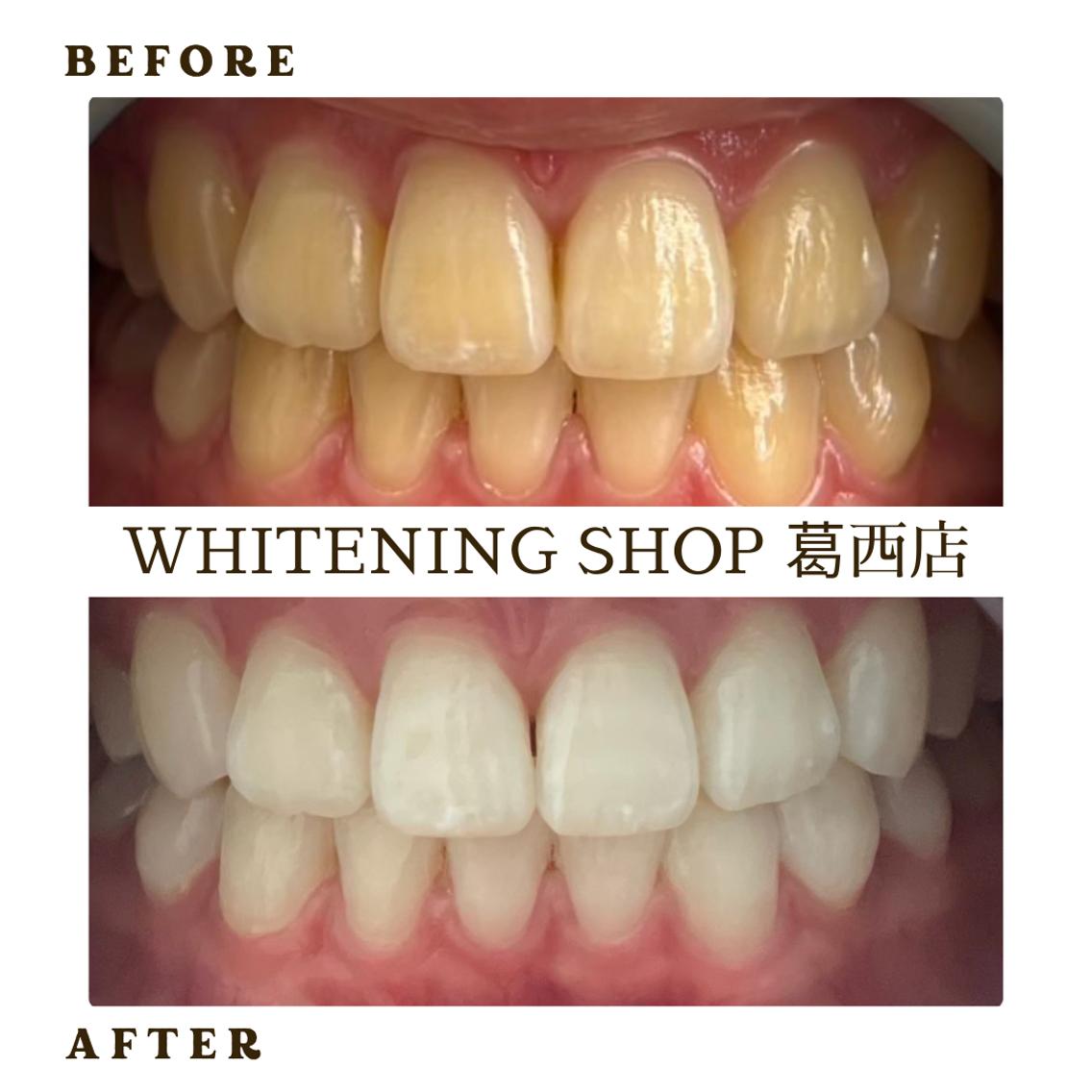 メンズ その他 ホワイトニング ショップ葛西店のその他イメージ