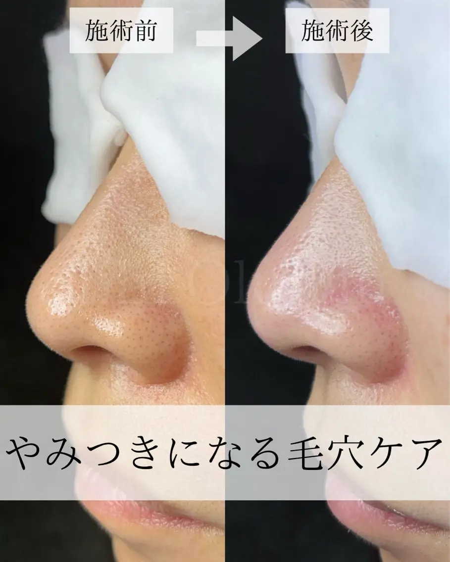 毛穴汚れ改善専門店/ 岸和田/リヒオルオルのエステ・リラクイメージ
