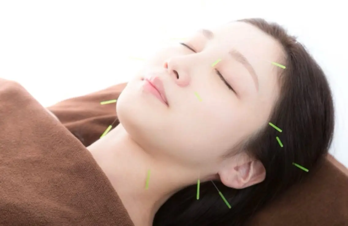 ✨むくみ撃退◎お試し即効小顔美容鍼 💆🏻✨¥7,700→¥0の写真