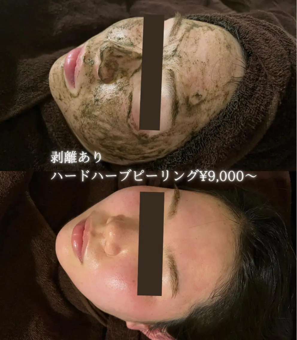 【キャンペーン】剥離ありハード・ハーブピーリング🌿がっつり皮剥けしたい方‼️ダウンタイム5〜7日間あり✨の写真