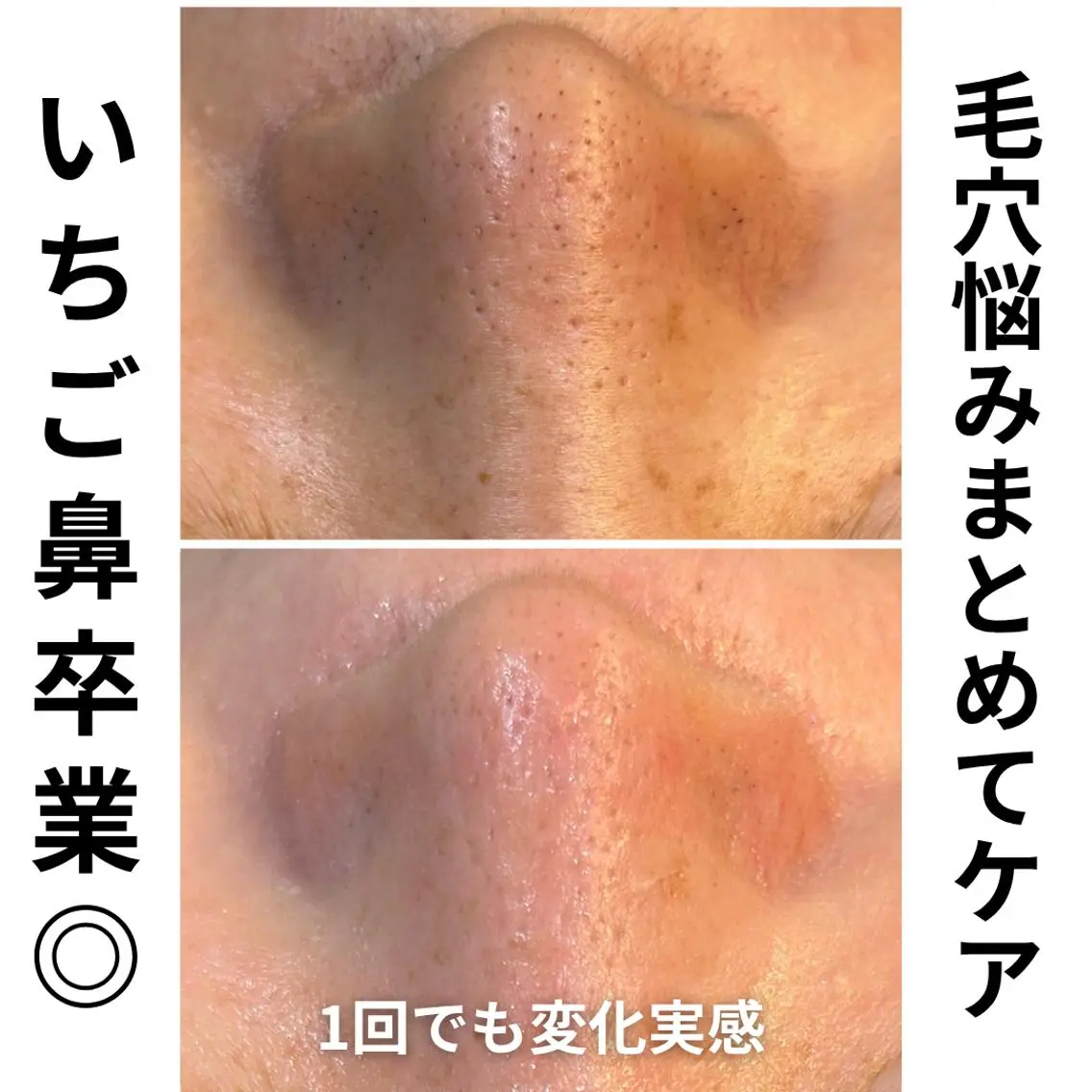 【9/18〜24限定特別価格】毛穴洗浄×肌悩み別美容液🔥黒ずみ・皮脂・ザラつきを集中ケア♪ 3000円引き!の写真
