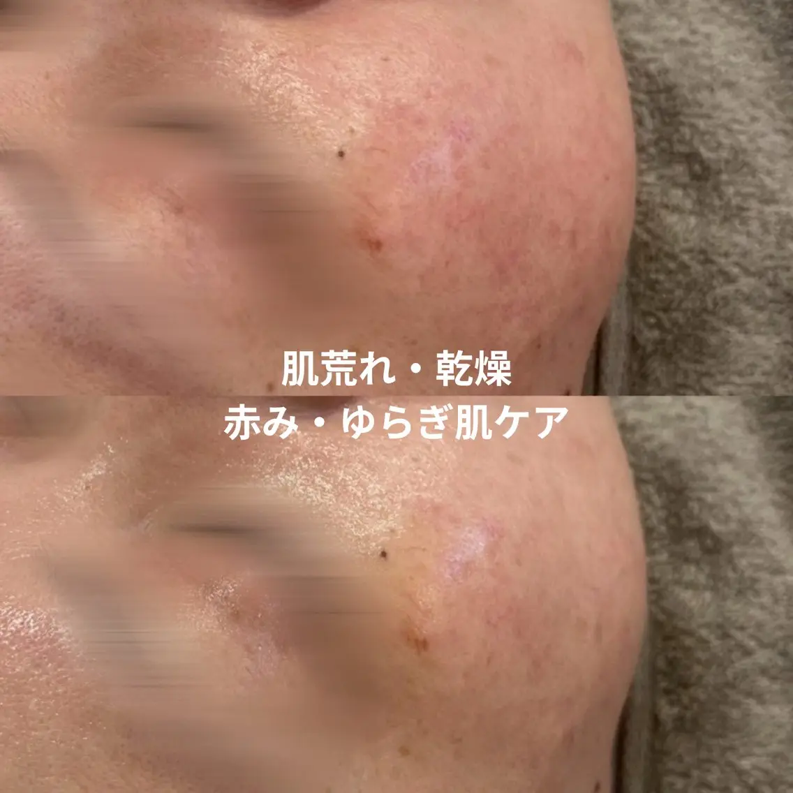 【初回】赤み・ゆらぎ肌ケア🌿季節の変わり目の肌荒れ・乾燥の写真
