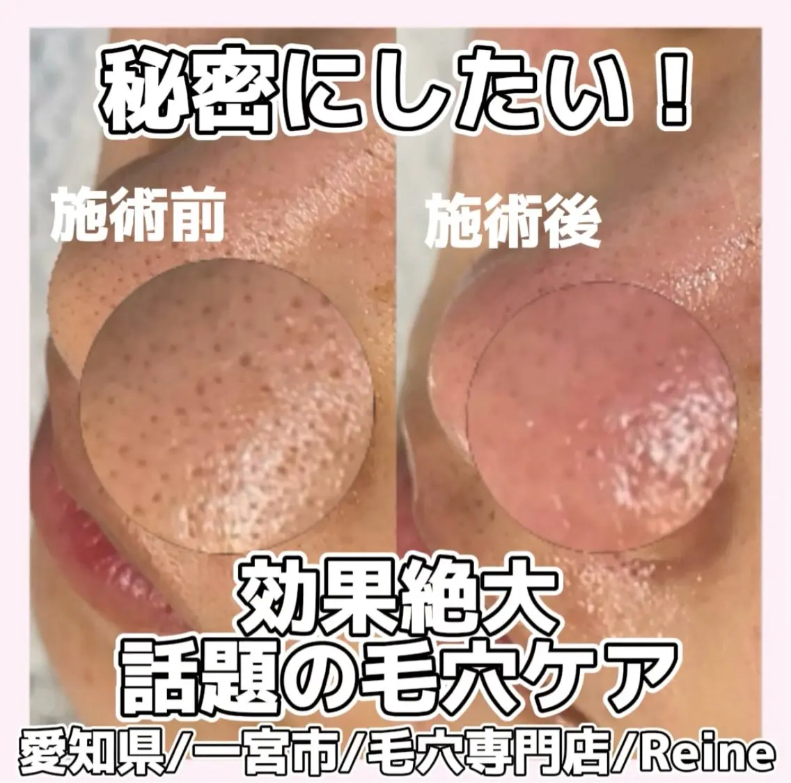 毛穴/シミ肝斑/脱毛 横山梨里のエステ・リラクイメージ