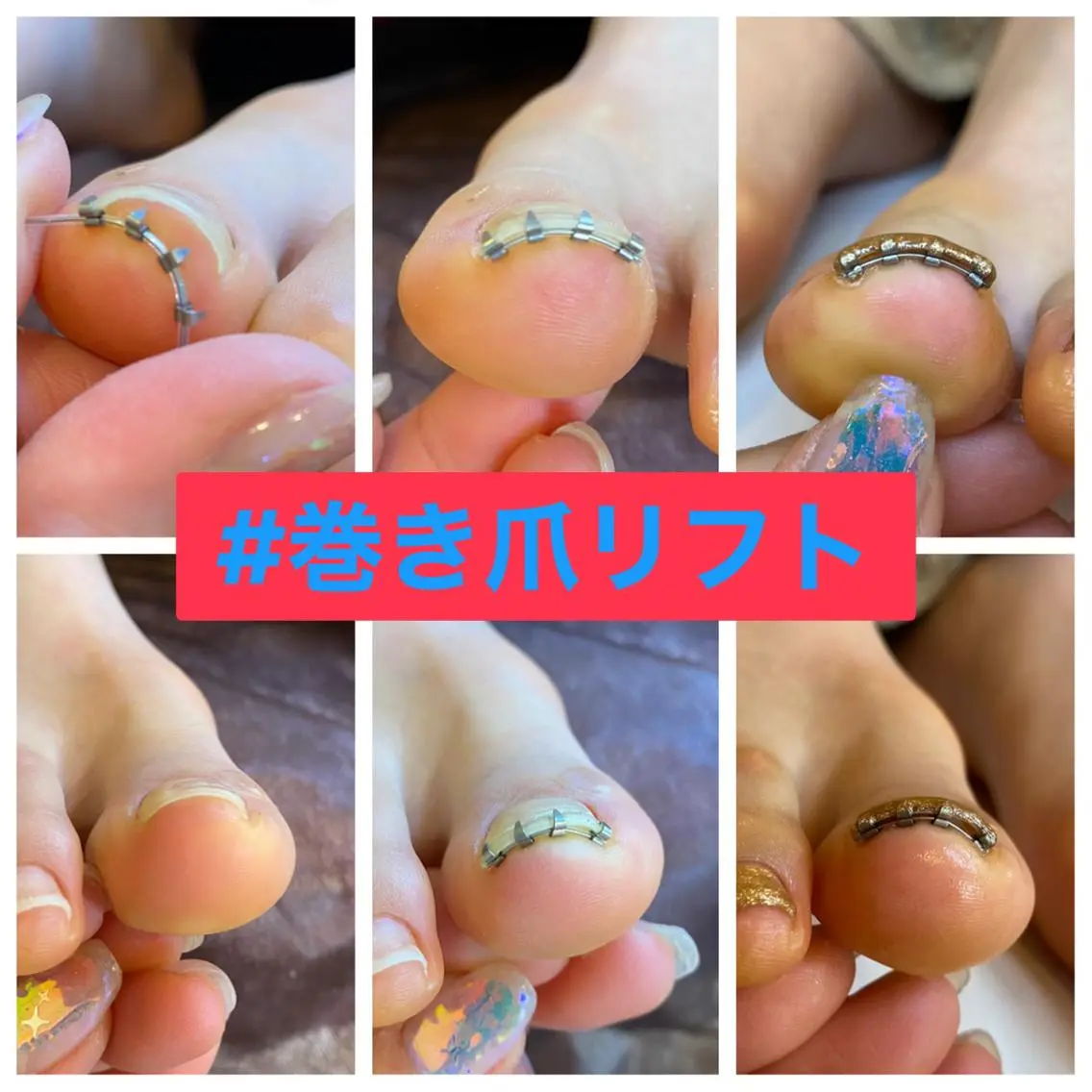ネイル ジェルネイル ♢ME2ROOM♢ #巻き爪#リラクのネイルデザイン