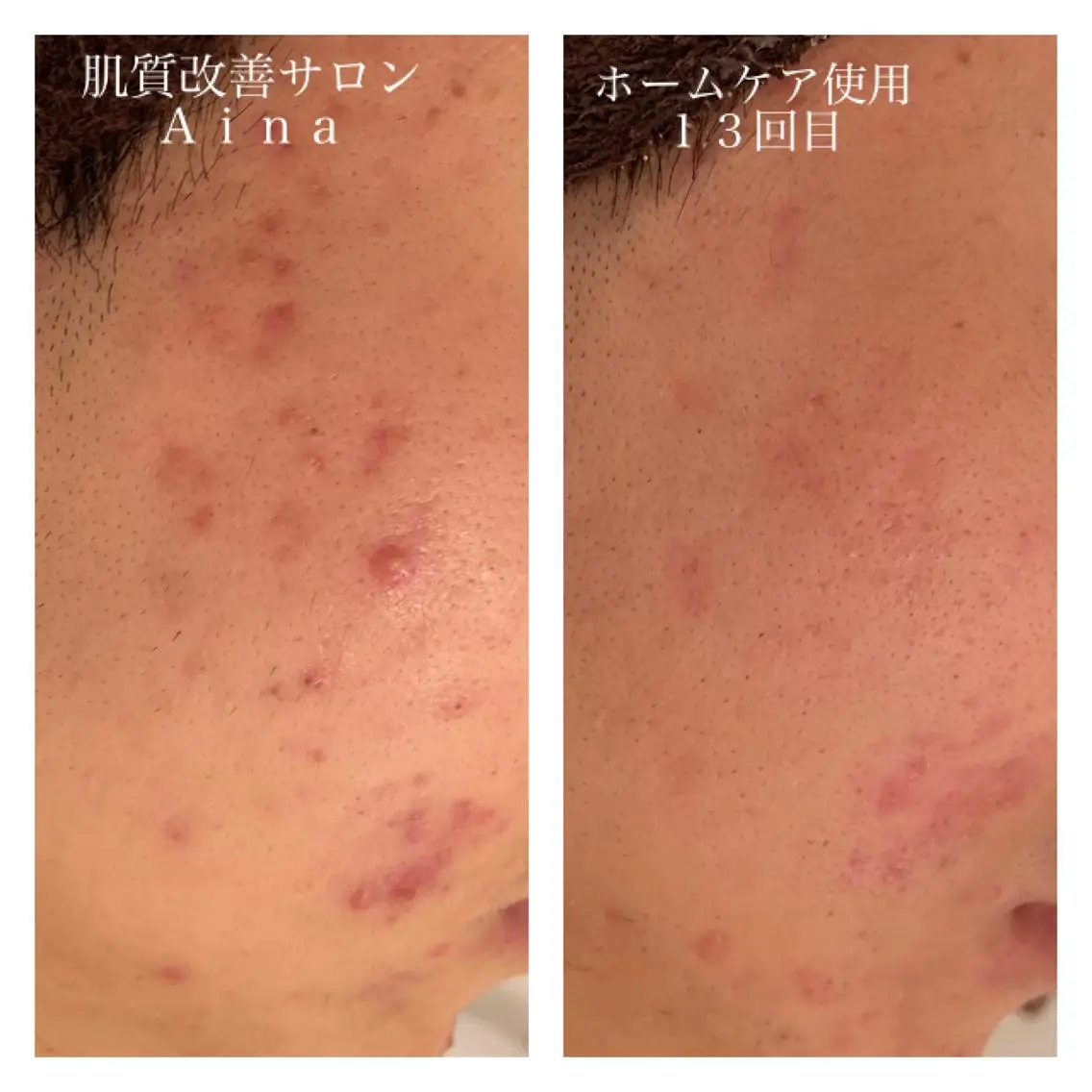 セミロング カラー パーマ ヘアアレンジ メンズ キッズ ネイル マツエク・マツパ 赤色 エステ リラク ニキビ跡専門サロン Ainaのエステ・リラクイメージ