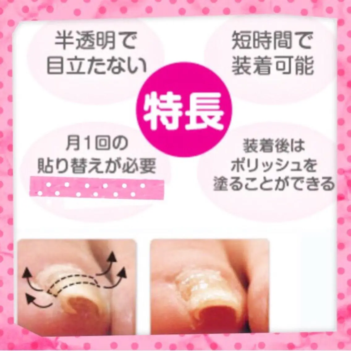 【巻き爪ケア(ドイツ式/ビーエス)】1趾(60分)の写真