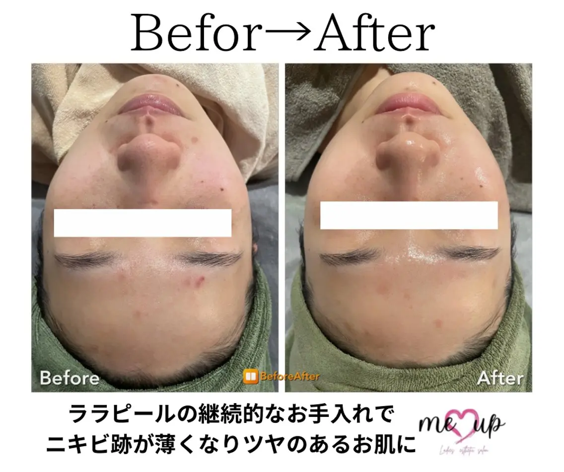 Meupニキビ専門店 背中/ハーブ/肌管理のその他イメージ
