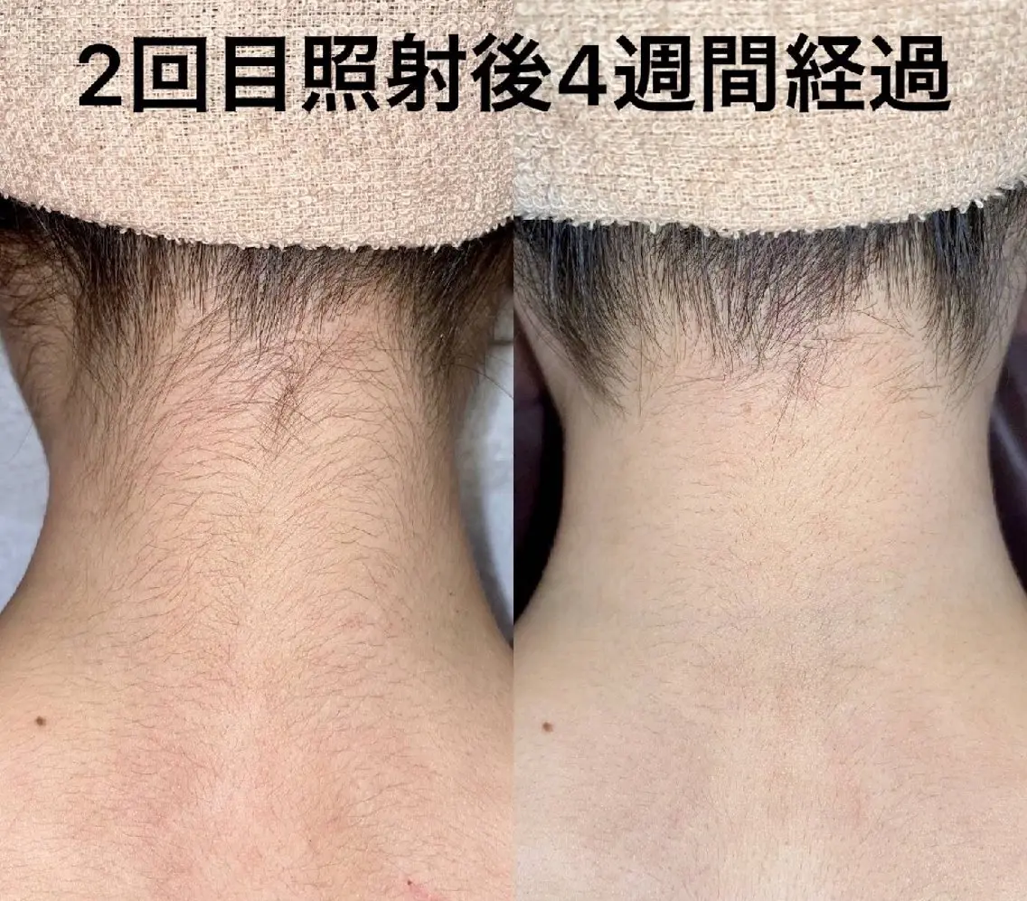 1か所脱毛(顔・髭・VIOは除く)の写真