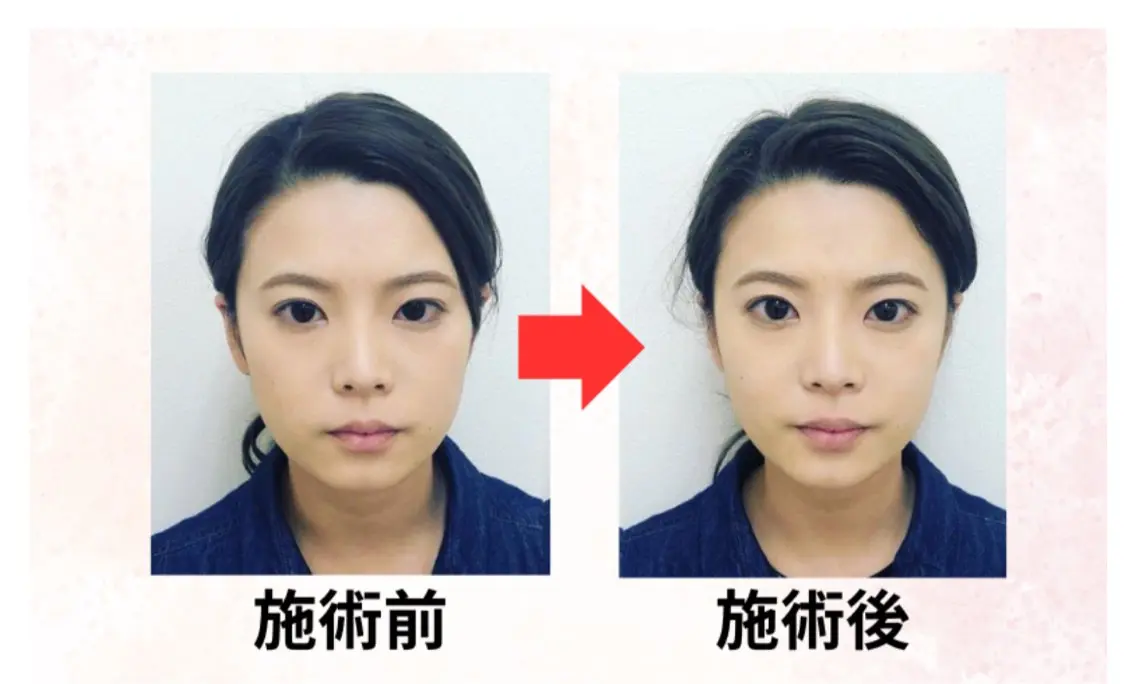 小顔整体の写真