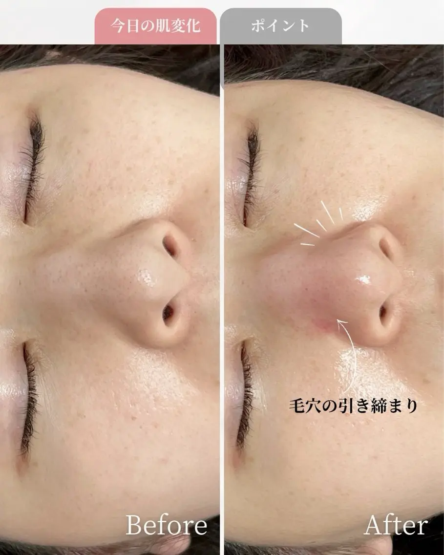 平日限定！NEWオープン特別《毛穴洗浄＋毛穴吸引》気になる鼻の毛穴ごっそりとれる！ザラつき鼻さようなら🌈お試しクーポンの写真