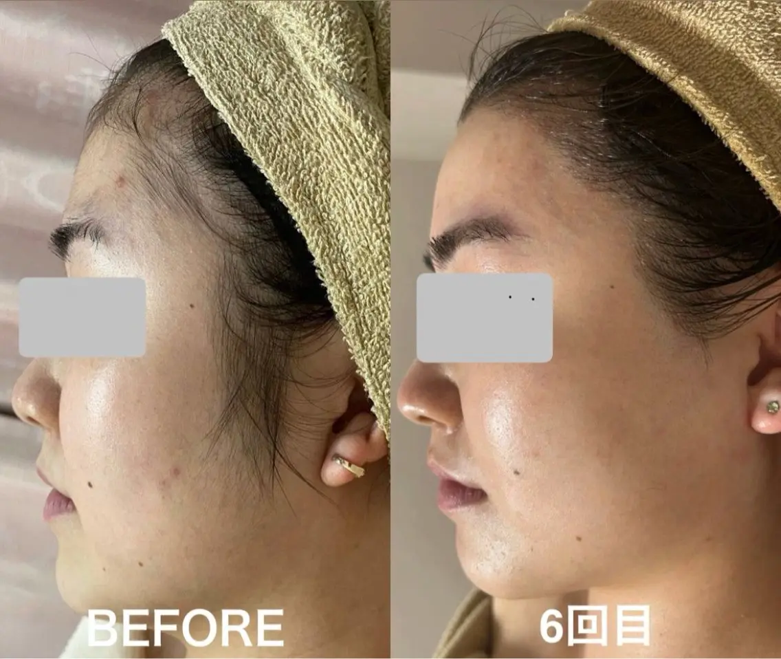 毛穴メイクノリの悩みに🌿お顔脱毛 1回¥3,900の写真