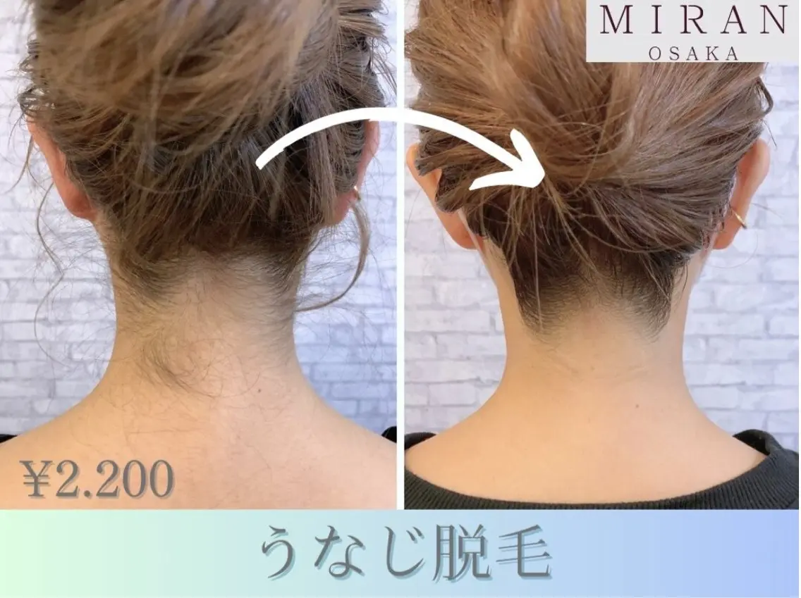 ☆男女OK☆うなじ脱毛☆シェービング、保湿付き☆￥2200の写真