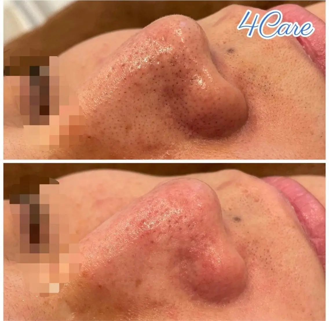 メンズ 4Care Yのネイルデザイン