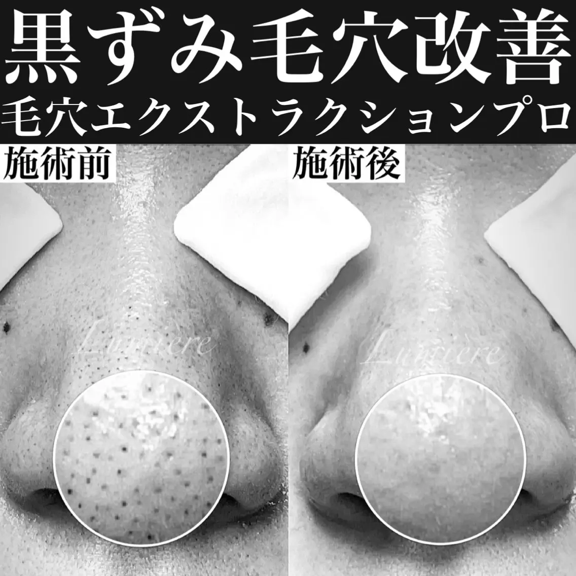 【ミニモ限定8,800円✨】毛穴エクストラクション　毛穴の黒ずみやざらつき改善×ビフォアフ撮影OKの方限定🎁の写真
