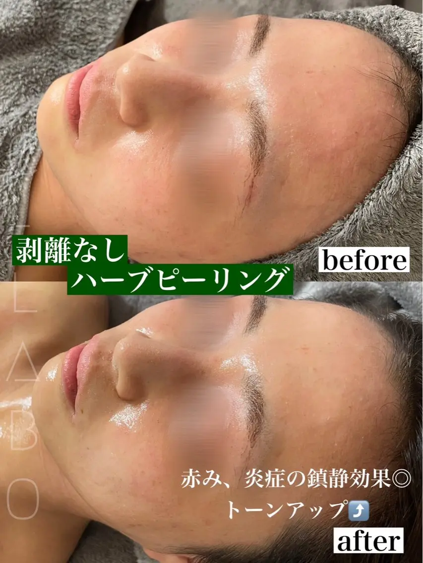 【平日限定】全顔メディカルハーブピーリング🌿【剥離/ダウンタイムなし】の写真