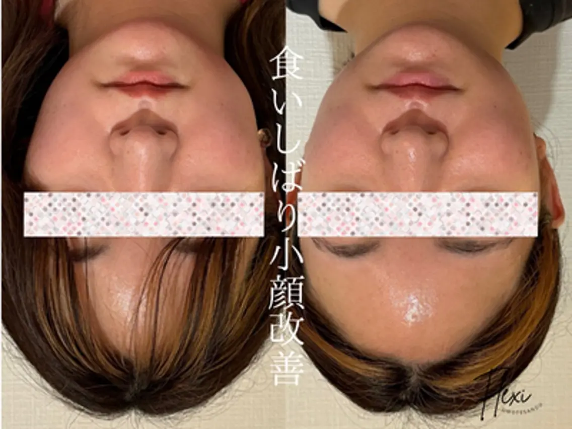 小顔矯正+美容整体コースの写真