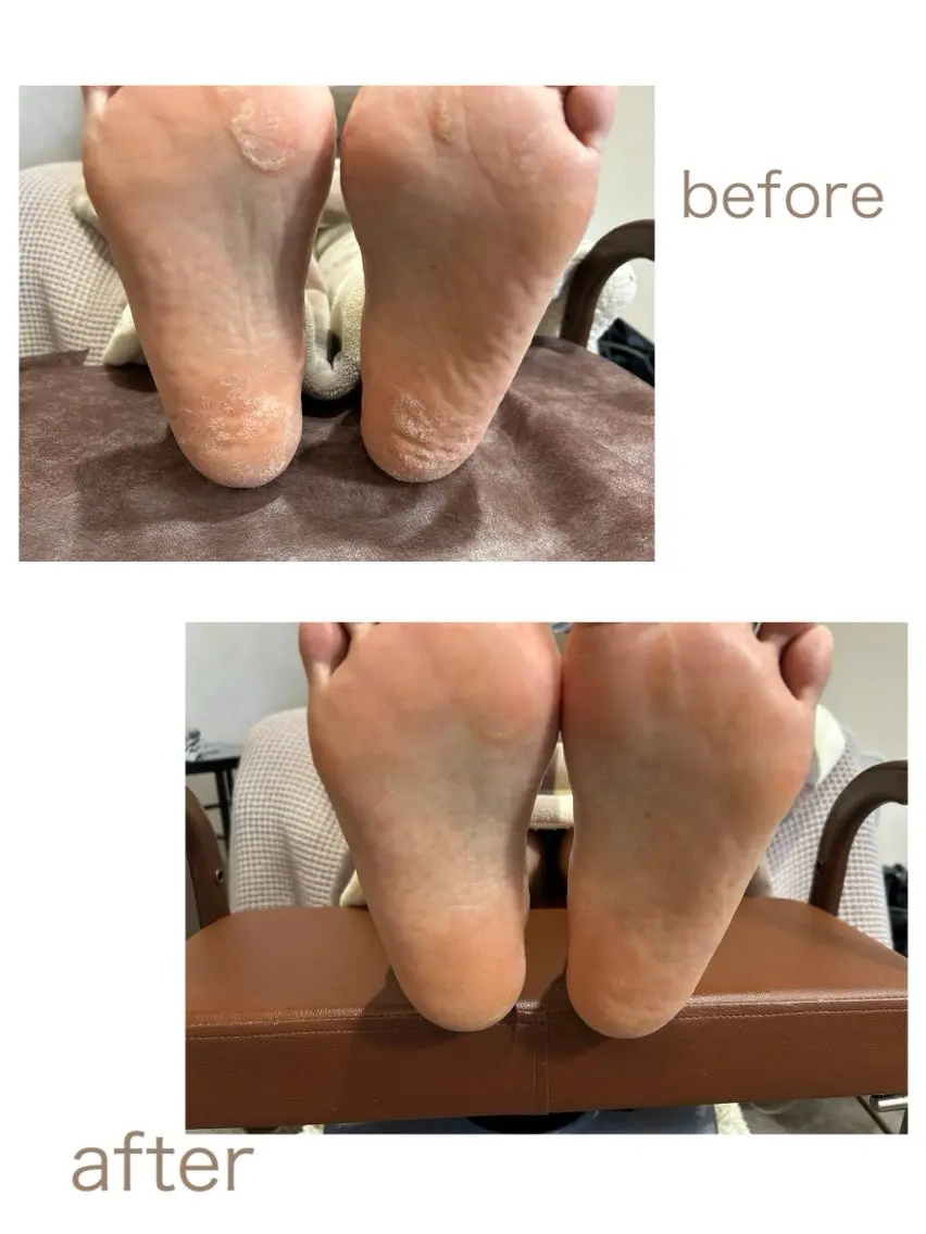 足裏つるつるケア(フットバス付き)の写真