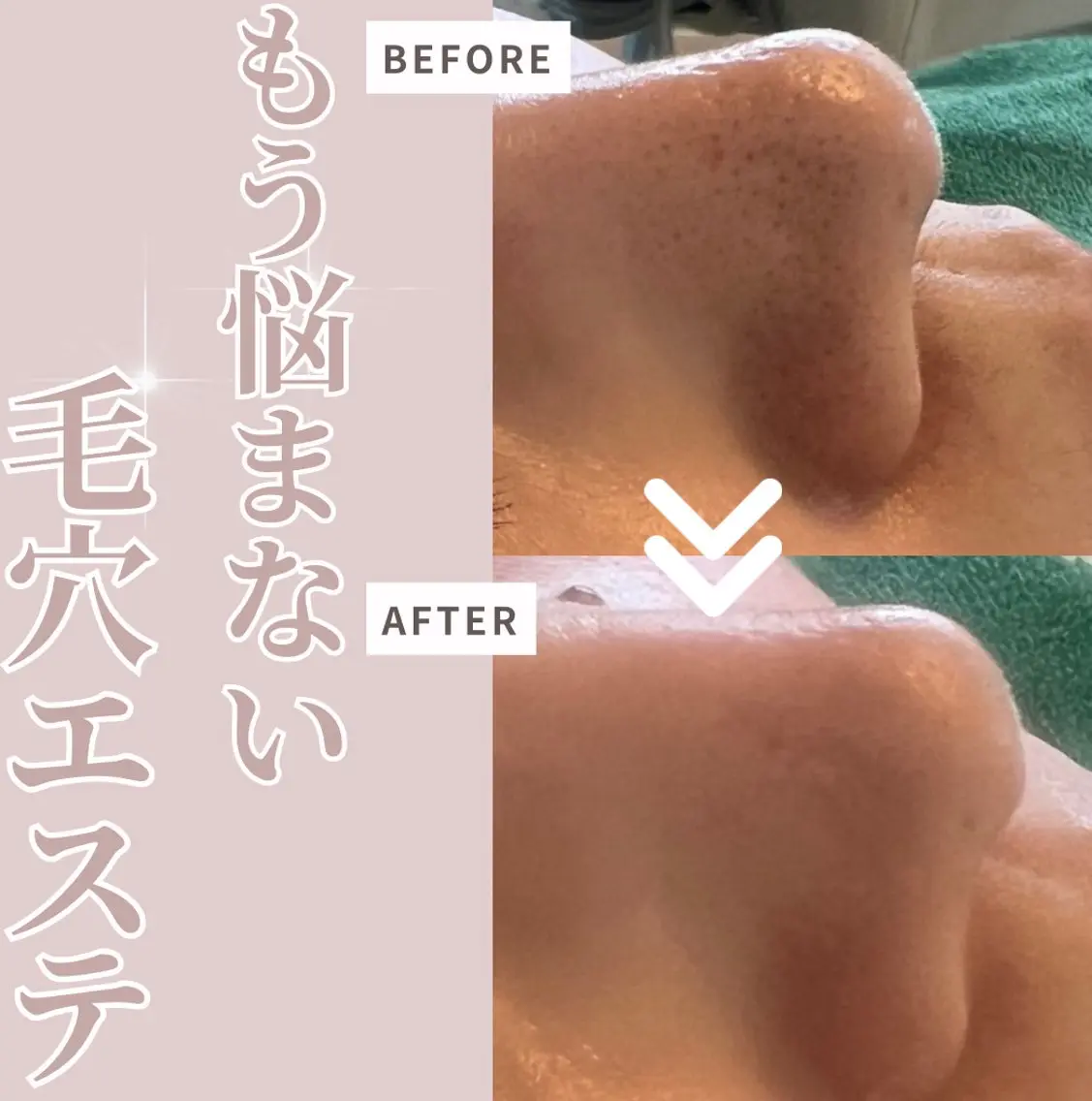 厚塗りファンデーションは卒業して毛穴レス美肌へ！！毛穴お掃除コースの写真