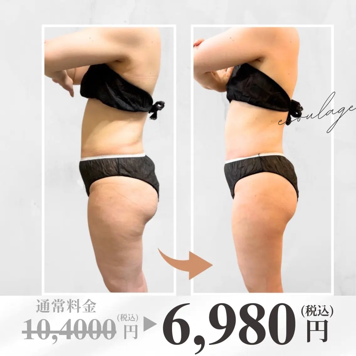 【口コミ限定★冷却痩身】《中型1カップ》冷却＋痩身マッサージの写真