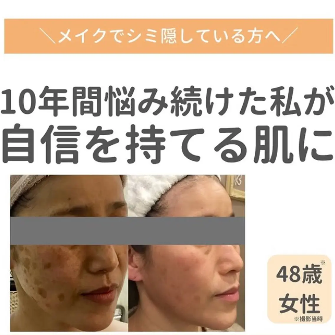 諦めていたシミ、任せてください！！【シミケア】集中美白・トーンアップコース（60分）の写真