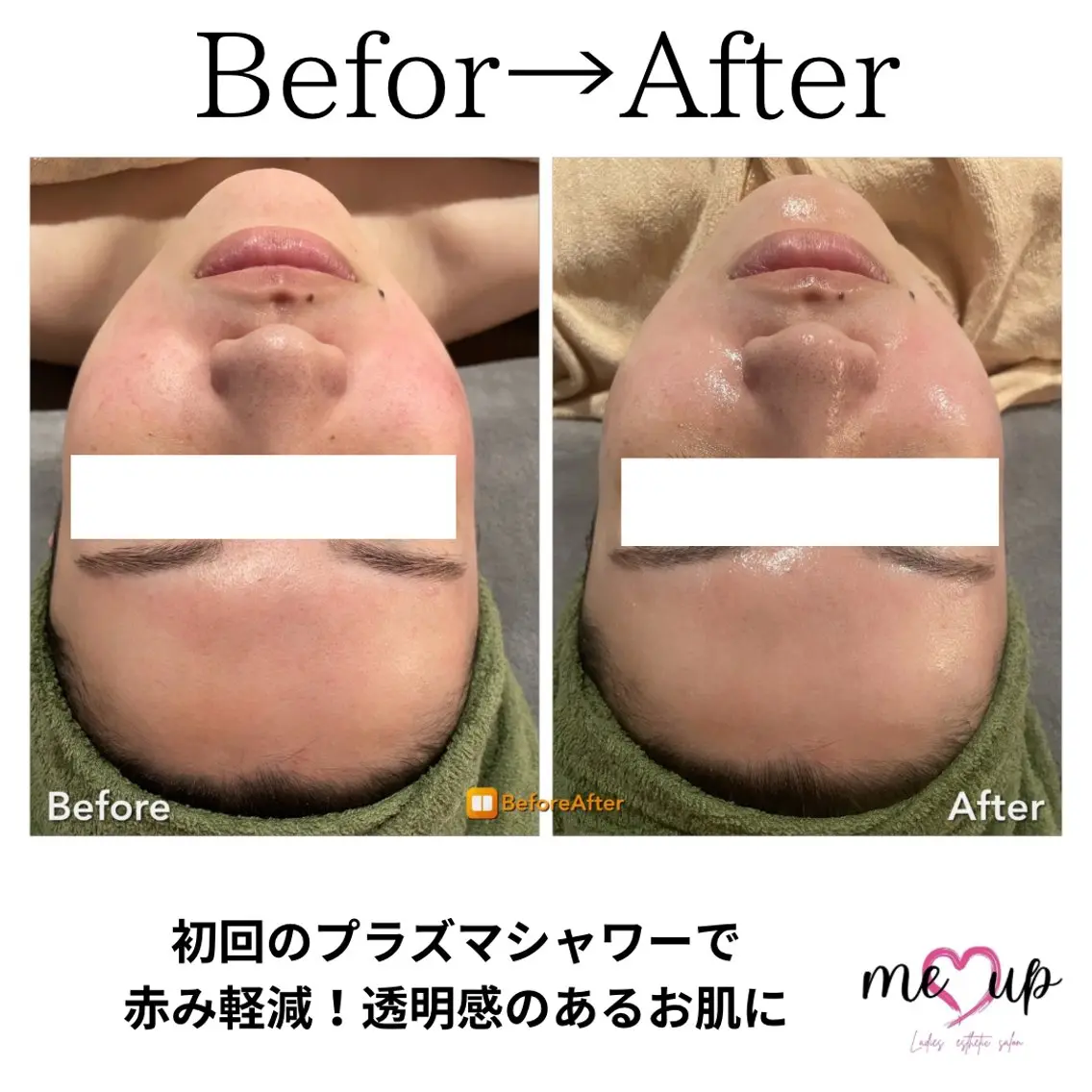 エステ Meupニキビ専門店 背中/ハーブ/肌管理のその他イメージ