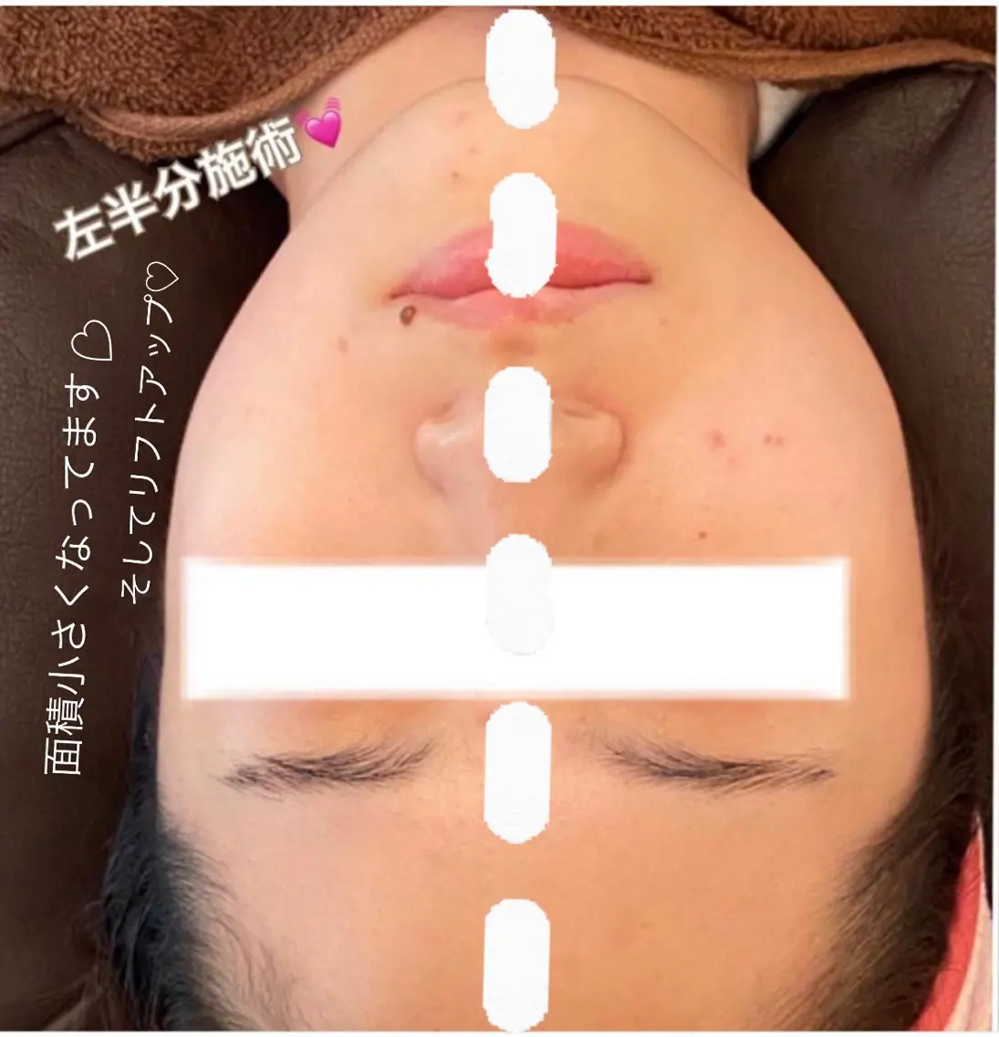 小顔整体💆‍♀️🫧小顔、左右差の歪み、小顔ケア、コラーゲンなど気になる方に✨の写真