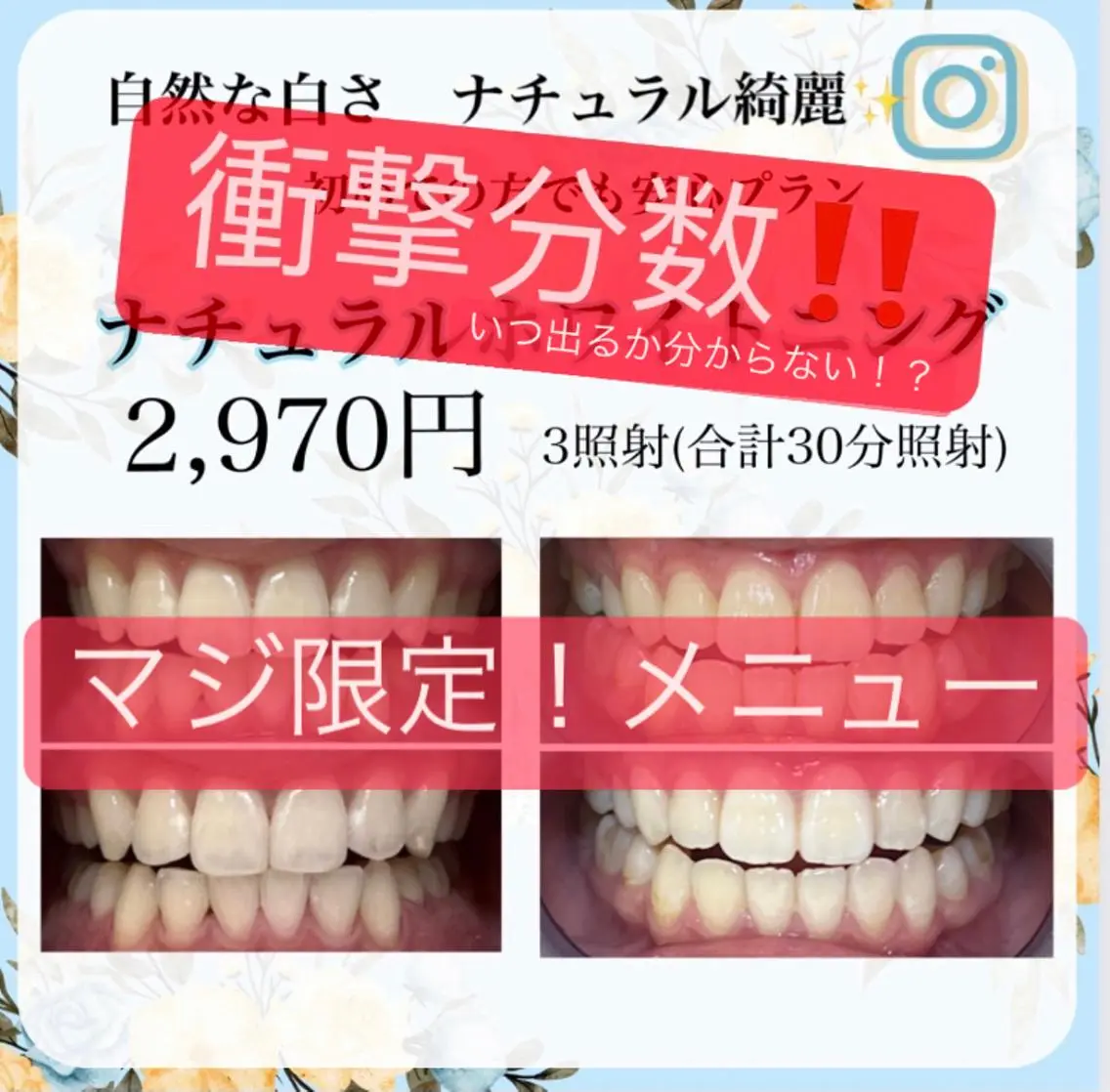 ⭐️【限定5名!】合計40分 ⭐️❤️20分✖️2照射📣しっかり効果!全体的に綺麗に!照射分数が長いからこその白さを!の写真