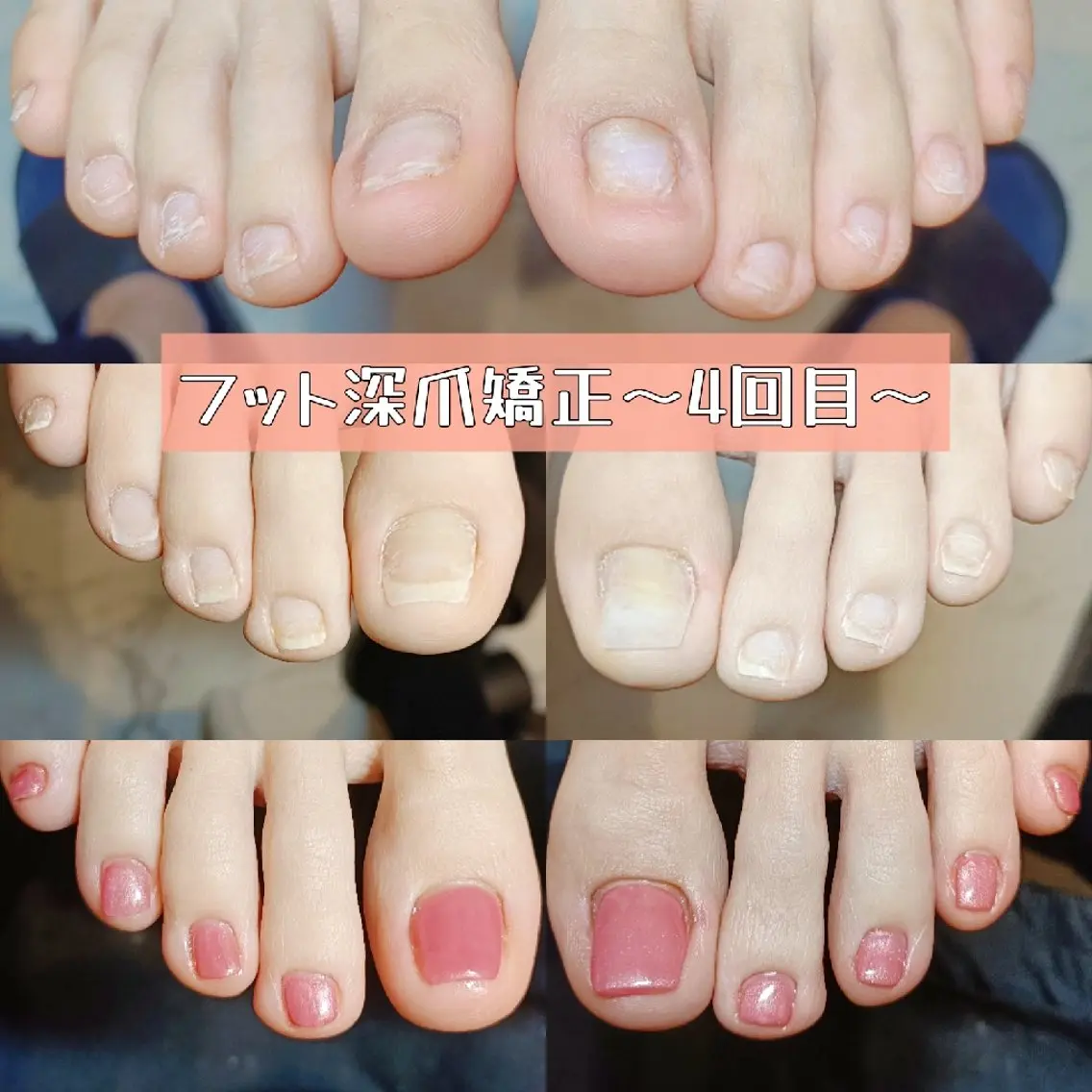 ネイル フットネイル 深爪矯正/爪育成ケア manie nailのネイルデザイン