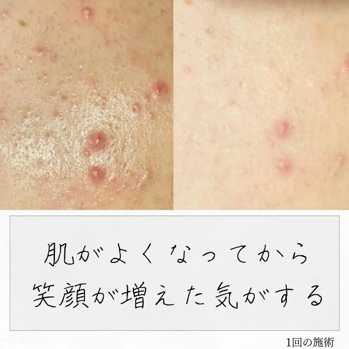ニキビ経験者が施術 する専門サロン🌻のエステ・リラクイメージ