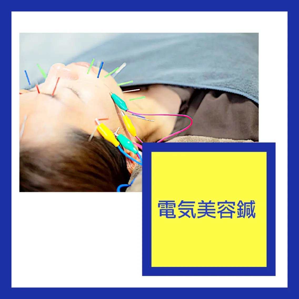 ダルダルにたるんだフェイスラインがきゅっと上がる【たるみ特化 電気美容鍼】初回お試しの写真