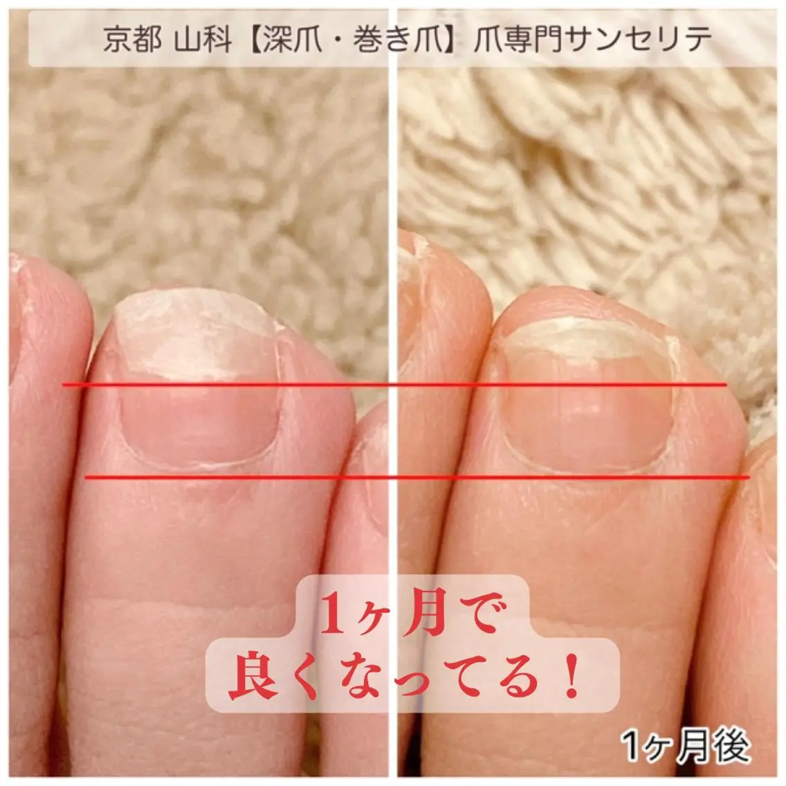 ネイル 巻き爪・肥厚爪ケア 専門サンセリテのネイルデザイン