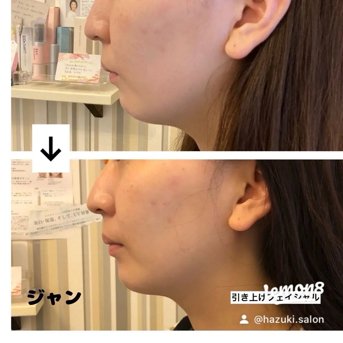【引き上げフェイシャル】　　　　　　　　　　　　　　最新の超音速ーマシン&顔筋EMSの合わせ技　小顔◎たるみ◎の写真