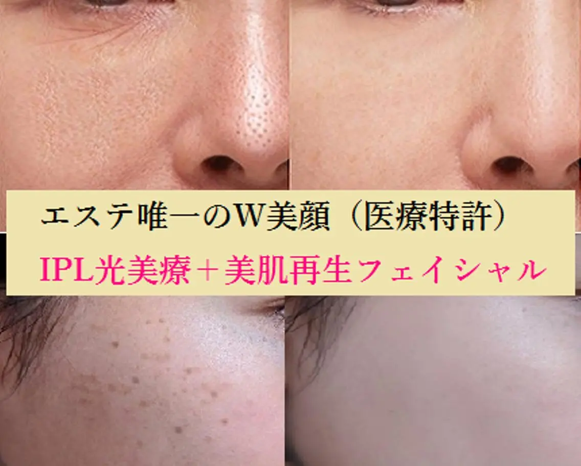 顔脱毛＆毛穴＆ニキビ 優良№1♪ヒロコ♪のエステ・リラクイメージ