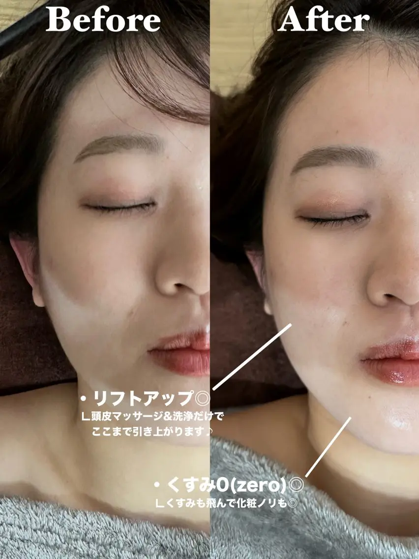 毛穴洗浄の写真