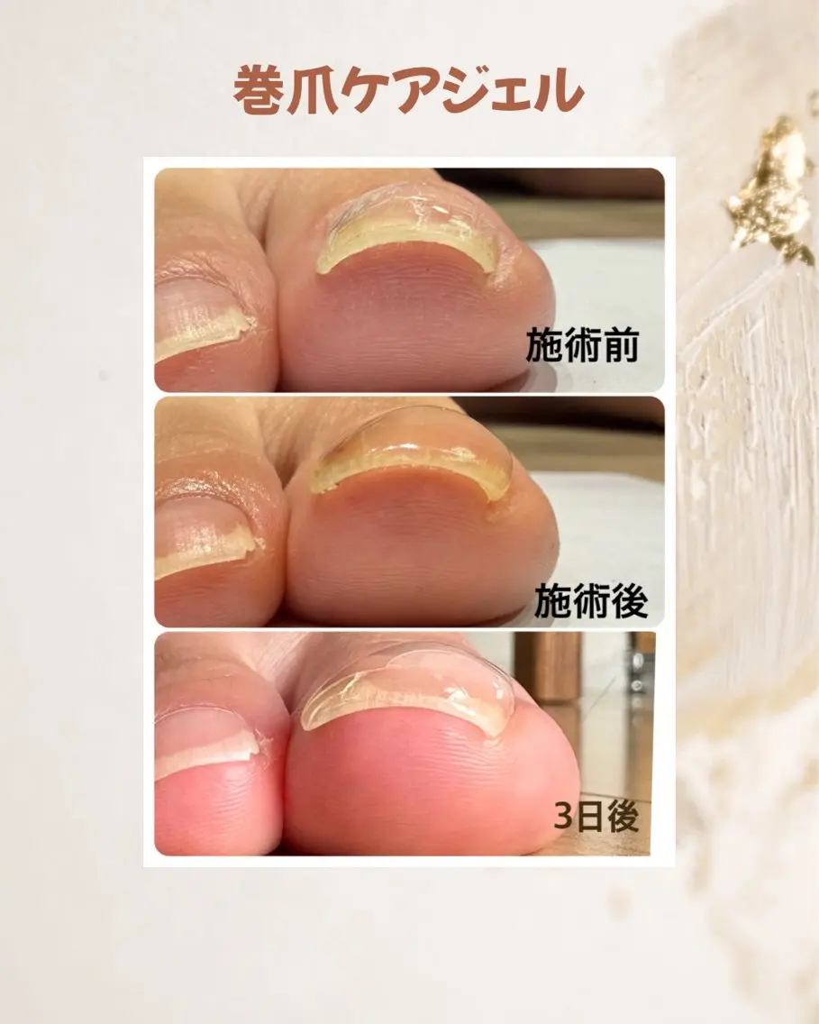 📣4月限定巻き爪ジェルモデル募集📣の写真