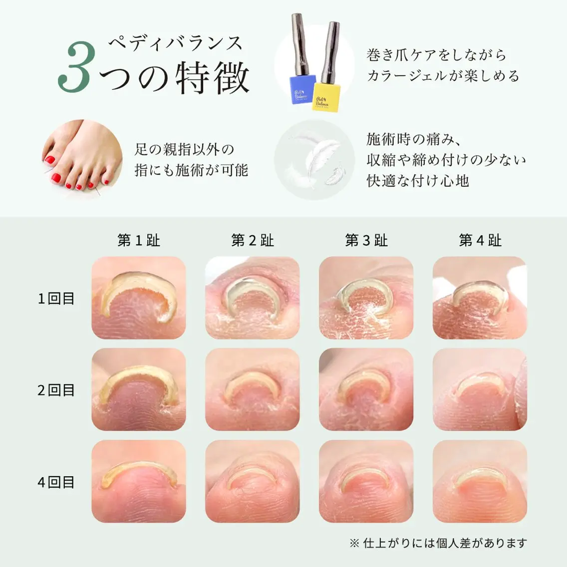 【巻き爪ケアジェル】4本(オフなし)の写真