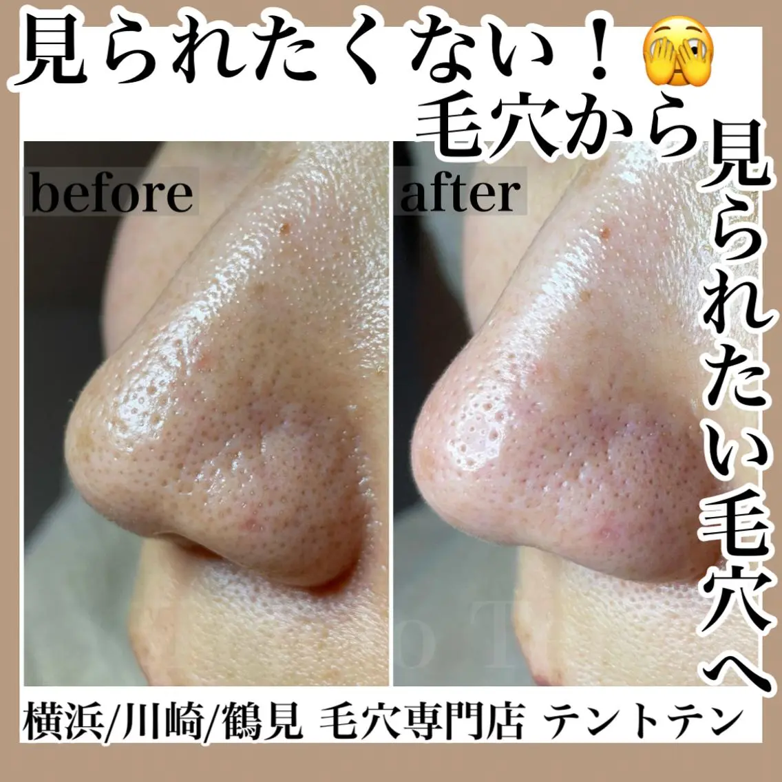 毛穴きれい!毛穴洗浄コースの写真