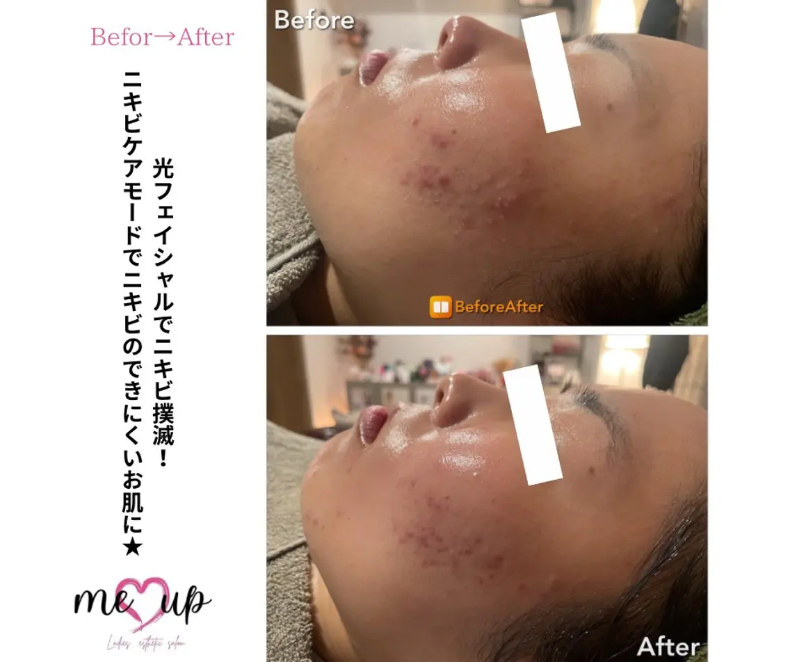 Meupニキビ専門店 背中/ハーブ/肌管理のその他イメージ