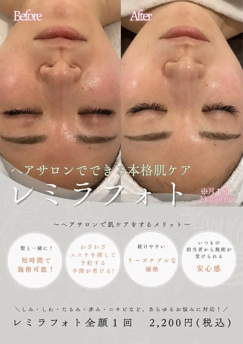 【透明感UP♪美肌フォト】 IPLの光でシミ・くすみ・毛穴・赤みにアプローチ♪の写真