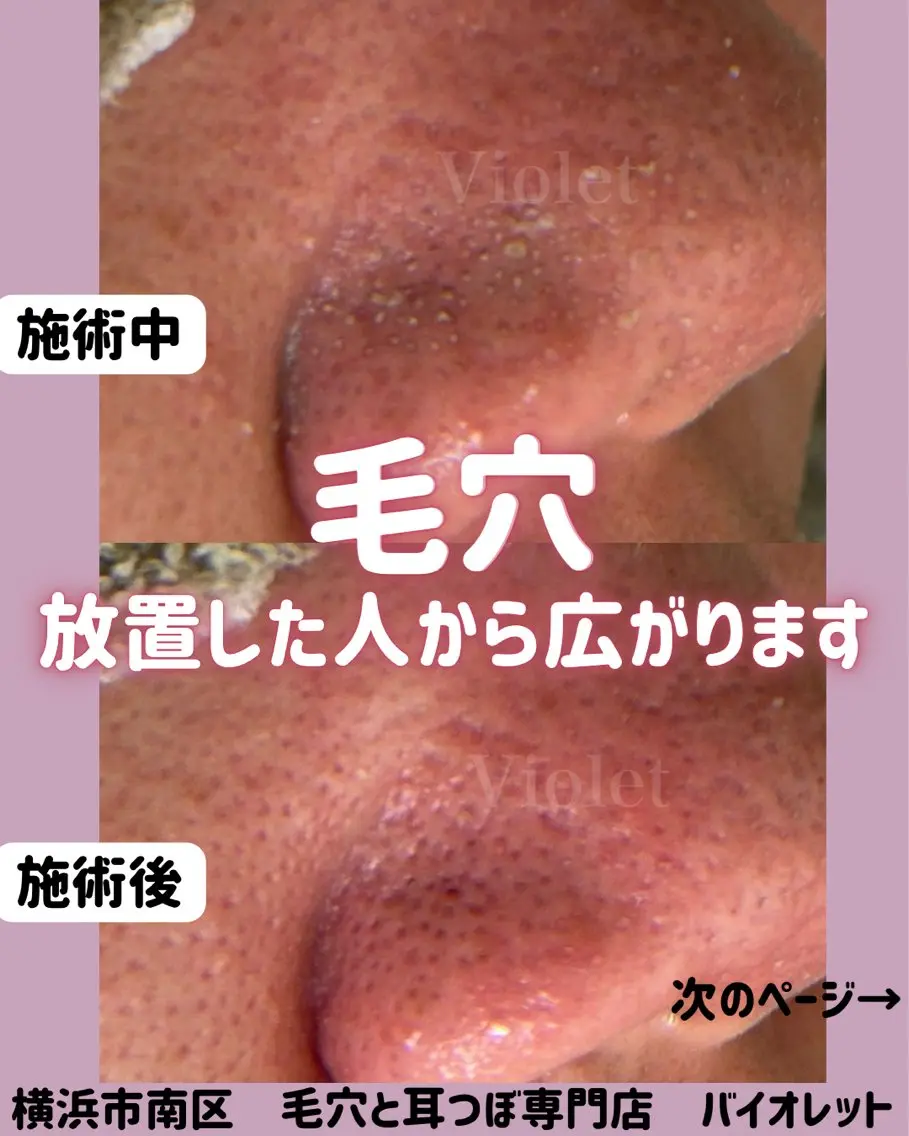その他 毛穴と耳つぼ専門店 バイオレット　りののその他イメージ