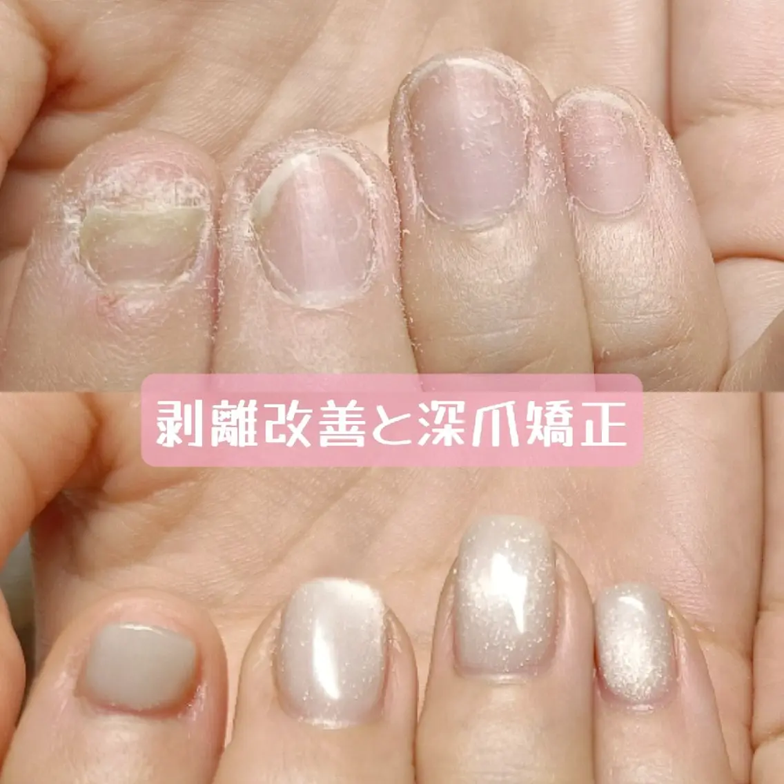 ネイル ハンドネイル ハンドケア 深爪矯正/爪育成ケア manie nailのネイルデザイン