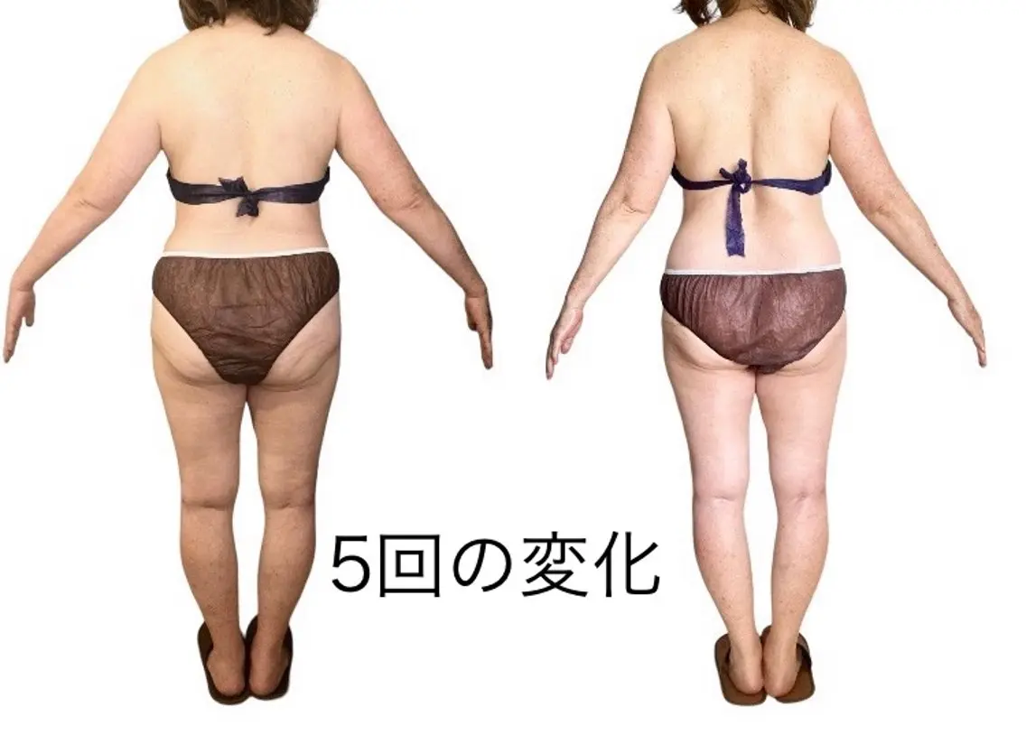 【姿勢×美ボディ】上半身筋膜リリース60分 巻き肩・二の腕・背中ケア姿勢改善でライン引き締めの写真