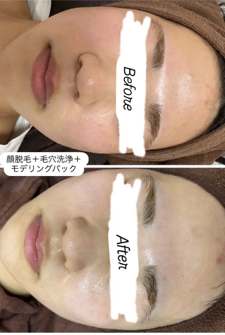 今日のイチオシ‼️毛穴の悩み撲滅‼️顔脱毛&毛穴洗浄✨️の写真