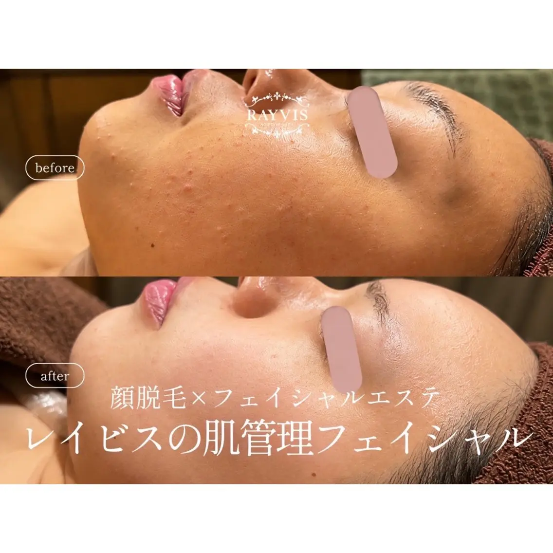 脱毛 レイビス盛岡店 ♡吉田♡のエステ・リラクイメージ