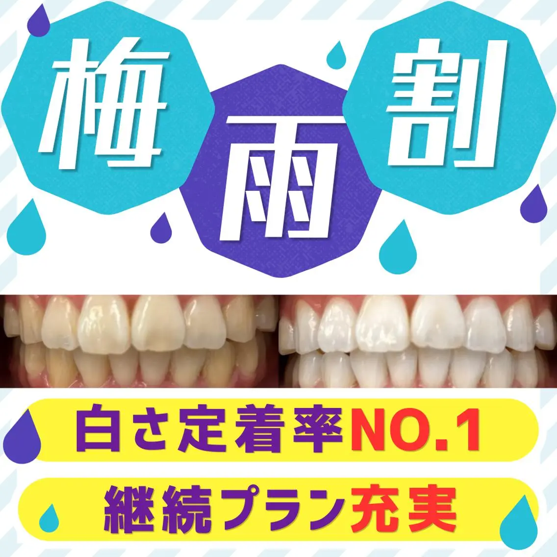 【本気で白くしたい方向け💁🏻♀️】8分照射×2回セルフホワイトニング✨※1回で白くしたい方のご希望には添えかねますの写真