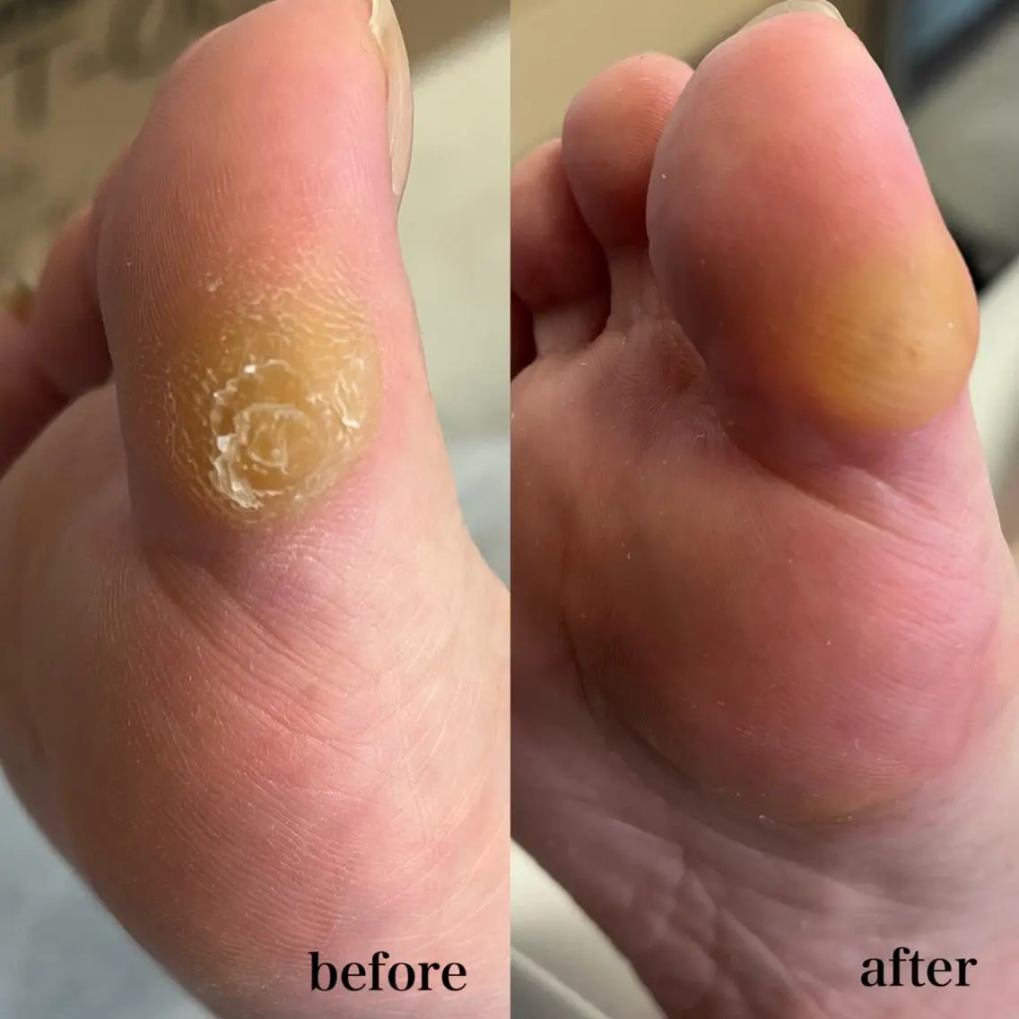 フットケア🦶🏻エステ《足裏のガサガサ・たこや魚の目が気になる方におすすめ》【フットバス･マッサージ･パック付】の写真