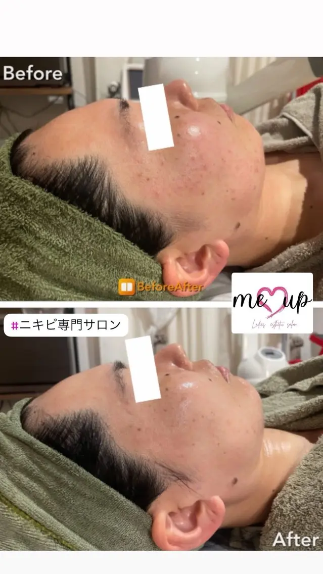 エステ Meupニキビ専門店 背中/ハーブ/肌管理のその他イメージ