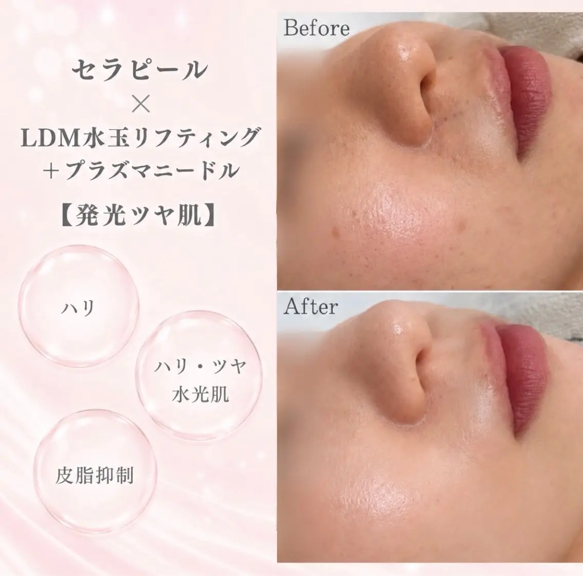 《発光ツヤ肌✨》セラピール+LDM水玉リフティング+プラズマニードル【 敏感肌・軽度のアトピーも施術可能◎】の写真