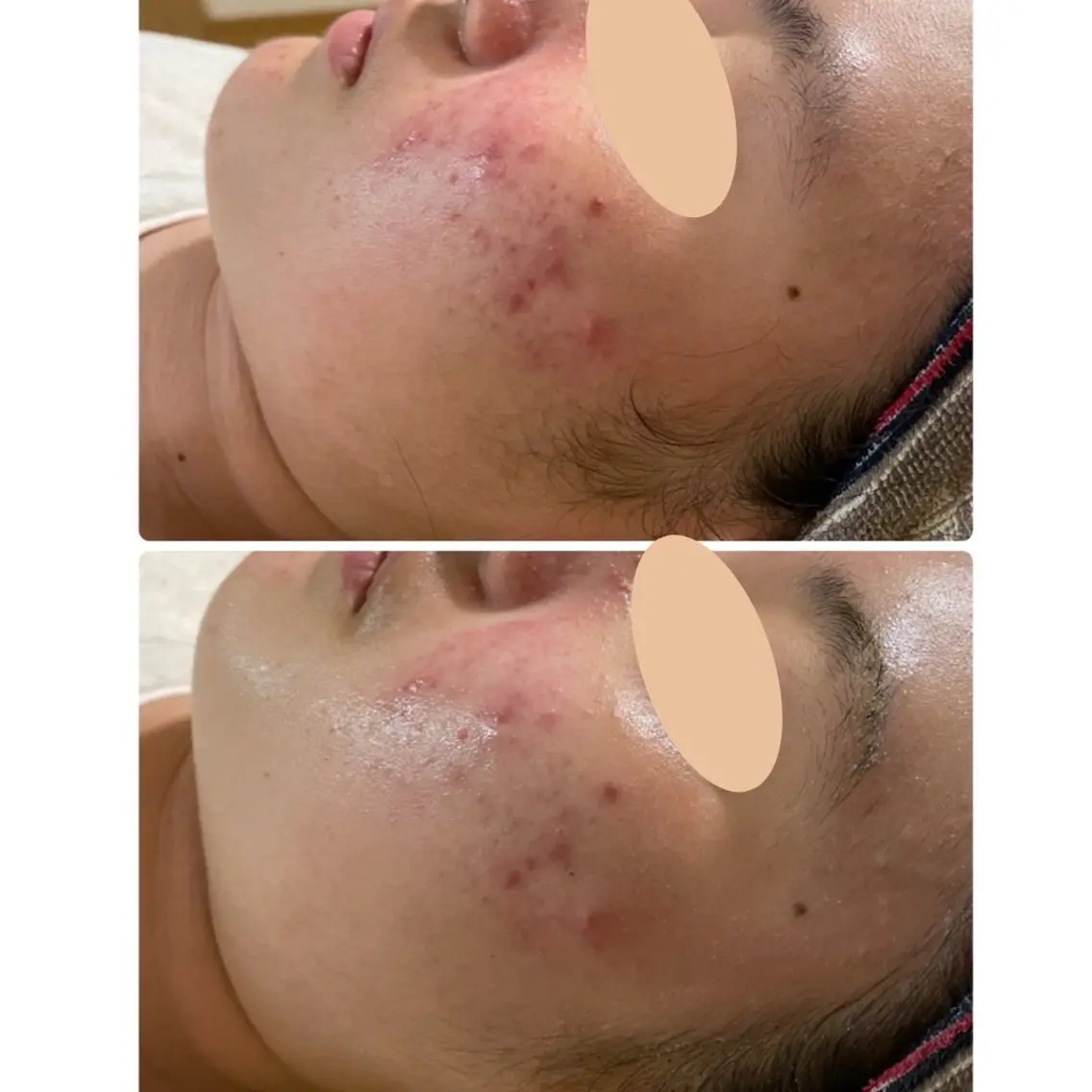 残り1名！|繰り返すニキビ・肌荒れ特化 |の写真