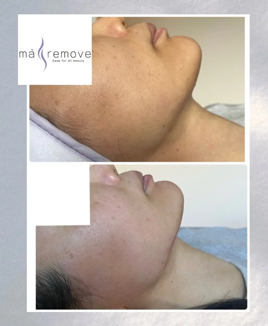 💆マリムーブ フェイシャルワックス 🫧回数を重ねる毎に美肌に近づきます🕊️化粧崩れや繰り返す肌荒れを改善したい方の写真